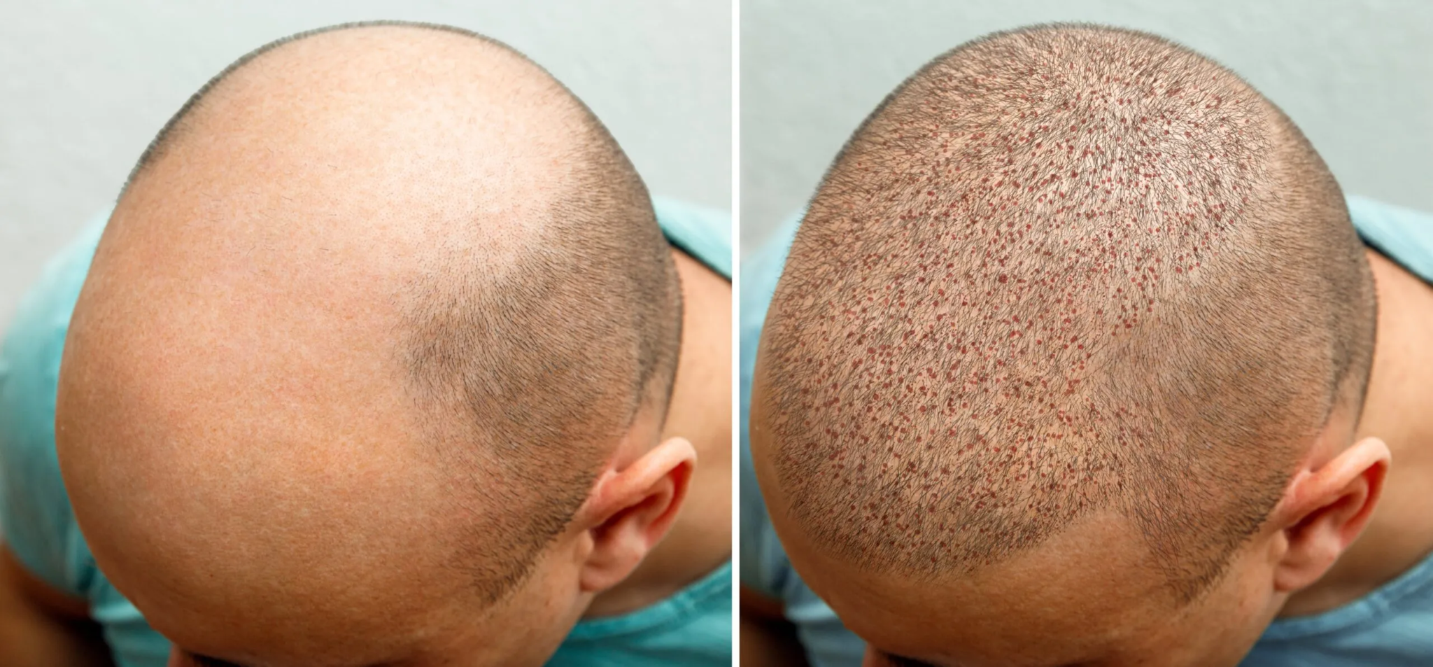 Hair Transplant Before And After